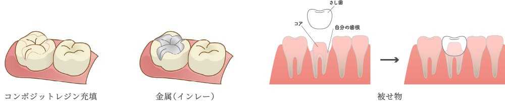 虫歯治療 イメージ画像